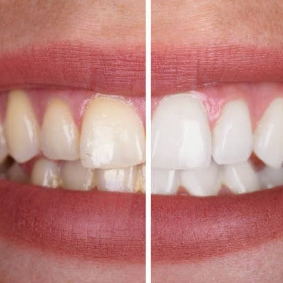 Brillaglo™ — Aufhellungsgel für ein strahlendes, selbstbewusstes Lächeln